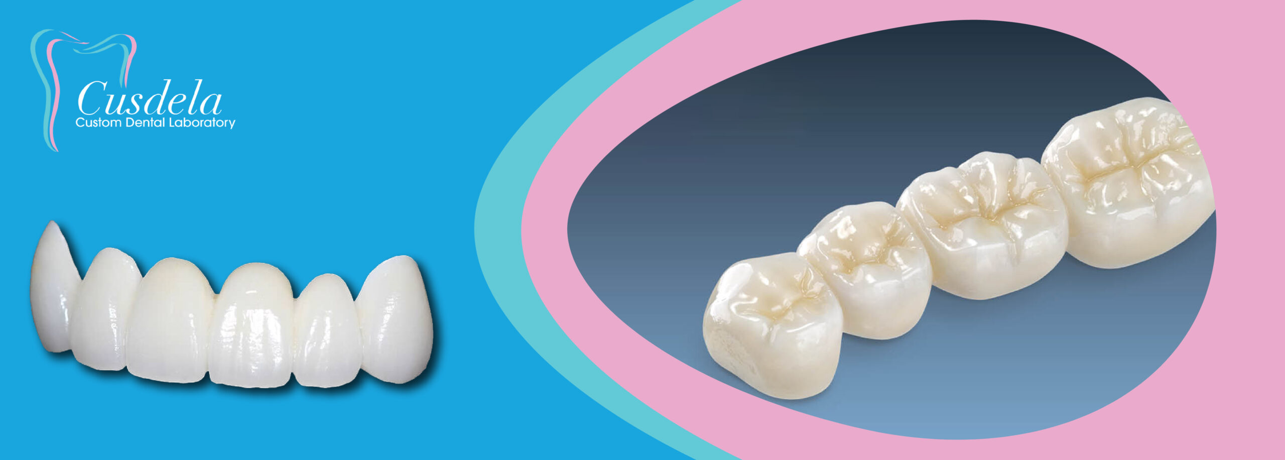 BruxZir Zirconia Crown Cusdela Custom Dental Lab