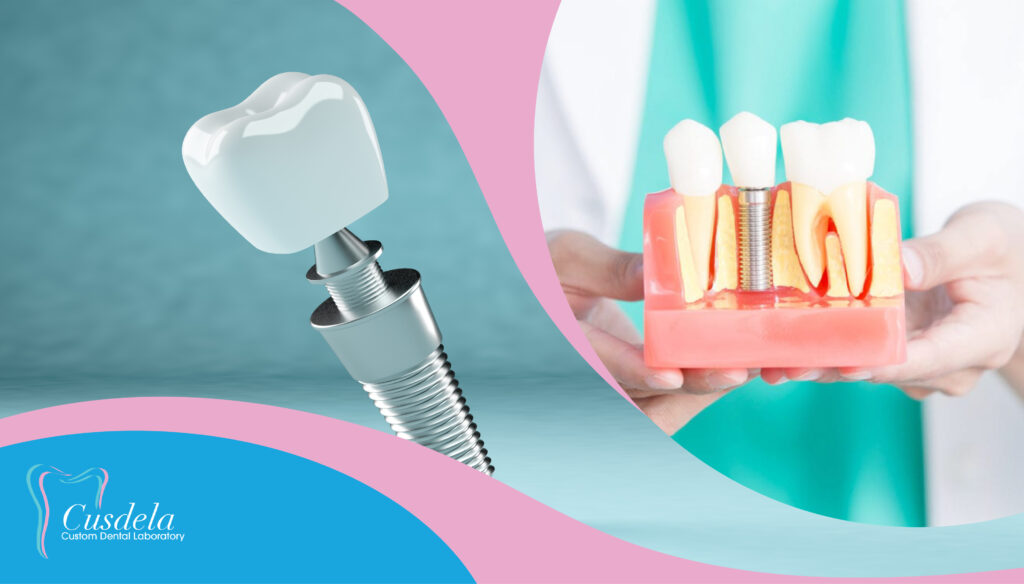 What are denture implants? Cusdela Dental Lab Blog
